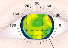 customized-wavefront-lasik-surgery