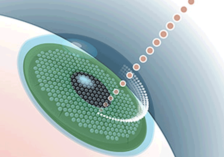 blade-free-intralaser-lasik-surgery-ambala