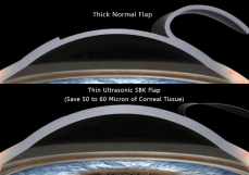thin-flap-sbk-lasik-laser-surgery-in-kolkata