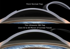 thin-flap-sbk-lasik-laser-surgery-in-ambala
