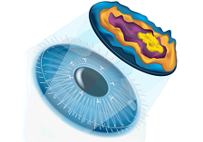 Aspheric-lasik-surgery