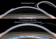 thin-flap-sbk-lasik-laser-surgery